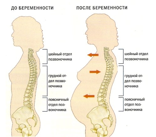 Возможности лечения лордоза поясничного отдела